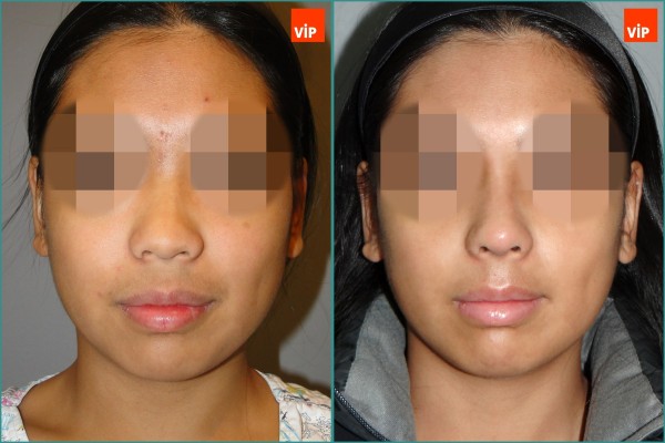 Nose Surgery - Nâng mũi bằng sụn sườn