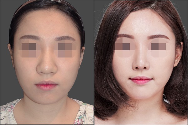 Nose Surgery, Stem Cell Fat Graft - Nâng mũi bằng sụn vách ngăn, Cấy mỡ