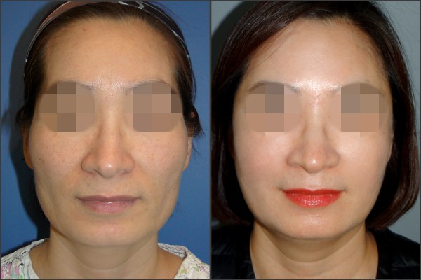 Stem Cell Fat Graft - Cấy mỡ