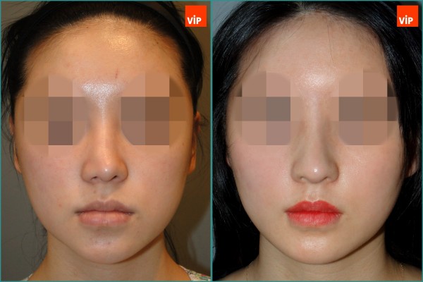Nose Surgery - Nâng mũi bằng sụn sườn
