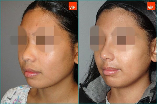 Nose Surgery - Nâng mũi bằng sụn sườn