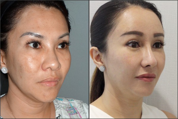 Nose Surgery, Eye Surgery, Face Lift, Stem Cell Fat Graft - Nâng mũi bằng sụn sườn, Nâng trán nội soi, Cấy mỡ, Mắt