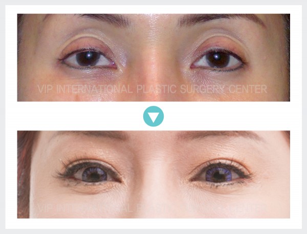 Eye Surgery, Stem Cell Fat Graft - Phẫu thuật sa mí mắt, Cấy mỡ