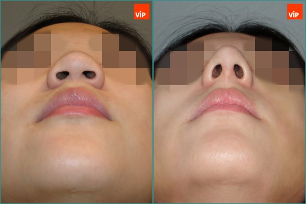 Nose Surgery - Nâng mũi bằng sụn sườn