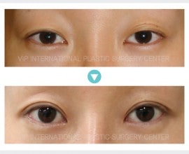 Phẫu thuật sa mí mắt