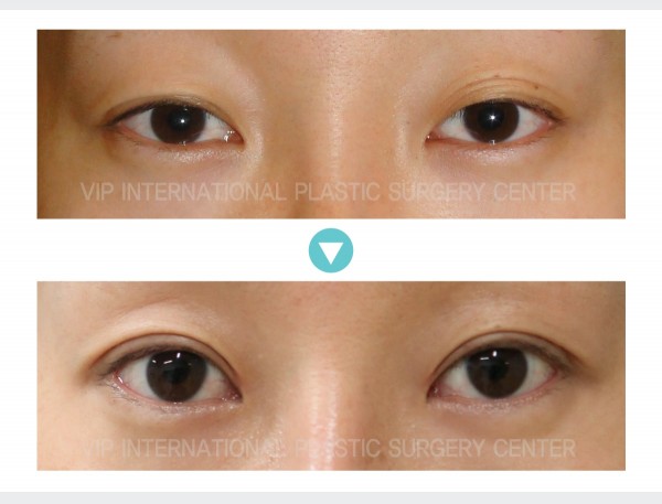Eye Surgery - Phẫu thuật sa mí mắt