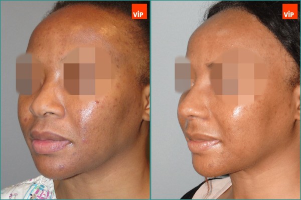 Nose Surgery - Nâng mũi bằng sụn sườn, Nâng vùng giữa mặt