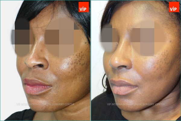 Nose Surgery - Chỉnh hình mũi lệch vách ngăn, Nâng vùng giữa mặt