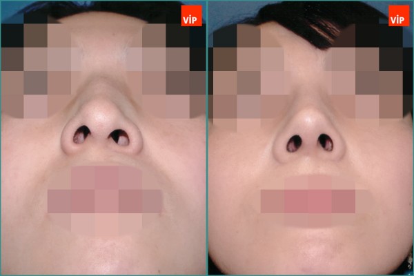 Nose Surgery - Nâng mũi bằng sụn vách ngăn