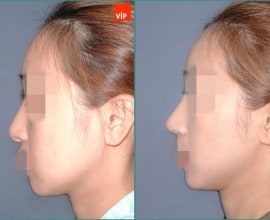 Nâng mũi bằng sụn vách ngăn