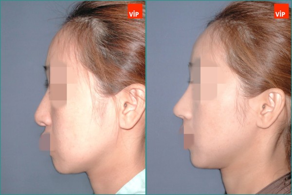 Nose Surgery - Nâng mũi bằng sụn vách ngăn
