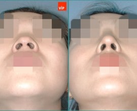 Nâng mũi bằng sụn vách ngăn