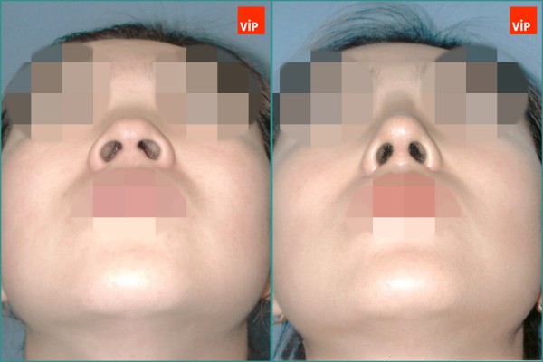 Nose Surgery - Nâng mũi bằng sụn vách ngăn