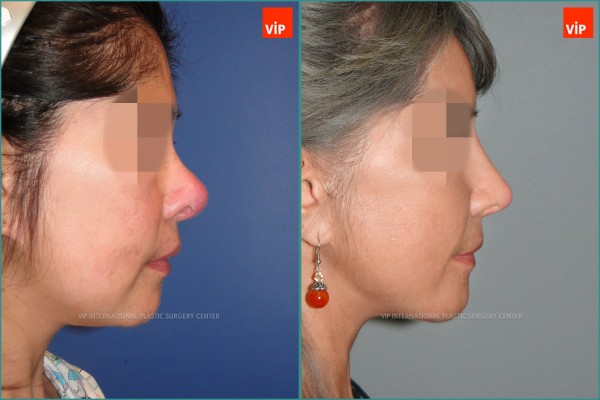 Nose Surgery - Căng da mặt, Tái phẫu thuật mũi, Nâng mũi bằng sụn sườn