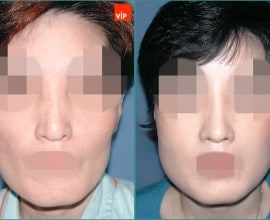 Nâng mũi bằng sụn sườn