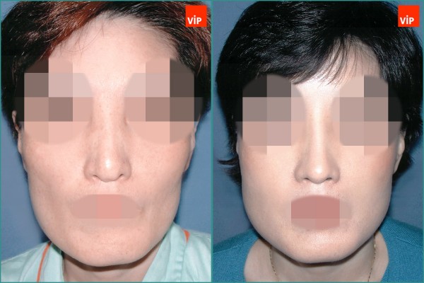 Nose Surgery - Nâng mũi bằng sụn sườn