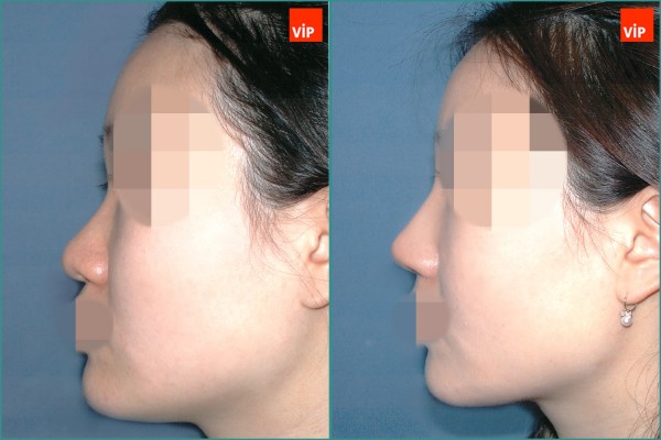 Nose Surgery - Nâng mũi bằng sụn vách ngăn