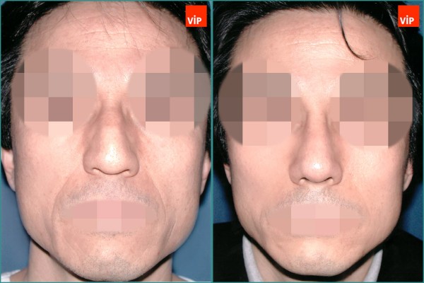Nose Surgery - Mũi gồ