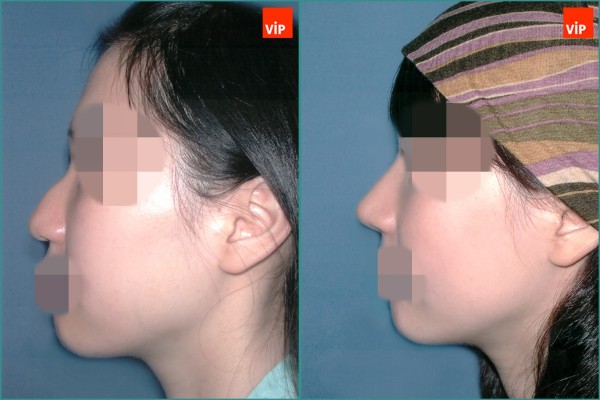 Nose Surgery - Mũi gồ