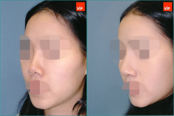 Nose Surgery - Nâng mũi bằng sụn vách ngăn