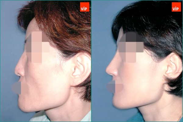 Nose Surgery - Nâng mũi bằng sụn sườn