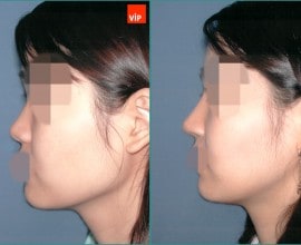 Nâng mũi bằng sụn vách ngăn