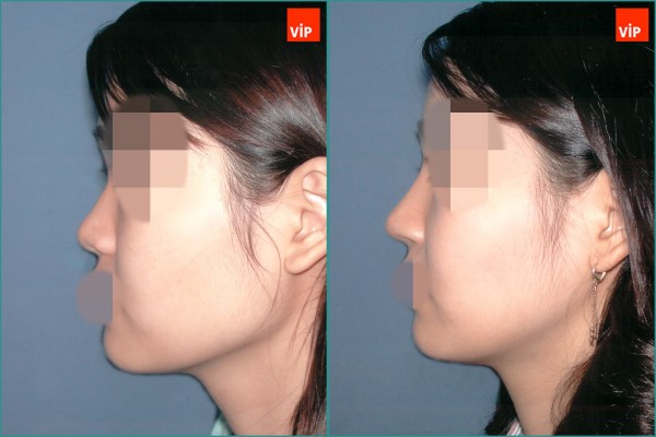 Nose Surgery - Nâng mũi bằng sụn vách ngăn