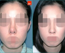 Nâng mũi bằng sụn sườn