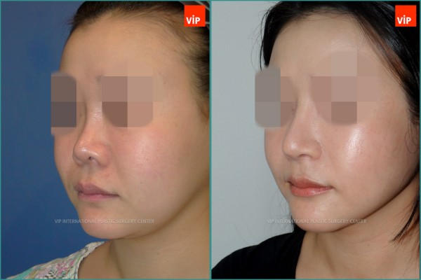Nose Surgery - Nâng mũi bằng sụn sườn, Nâng vùng giữa mặt