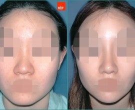 Nâng mũi bằng sụn vách ngăn