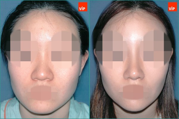 Nose Surgery - Nâng mũi bằng sụn vách ngăn