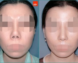 Nâng mũi bằng sụn sườn