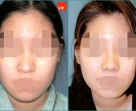 Nâng mũi bằng sụn vách ngăn