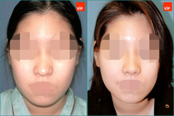 Nose Surgery - Nâng mũi bằng sụn vách ngăn