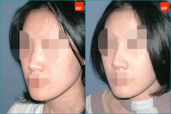 Nose Surgery - Nâng mũi bằng sụn vách ngăn