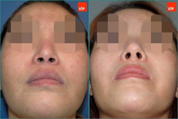 Nose Surgery - Nâng mũi bằng sụn sườn