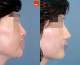 Nâng mũi bằng sụn vách ngăn
