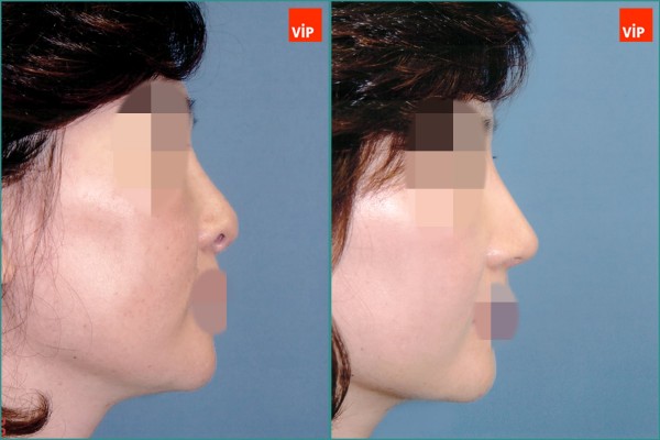 Nose Surgery - Nâng mũi bằng sụn vách ngăn