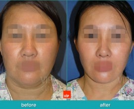 Căng da mặt/cổ High-Smas