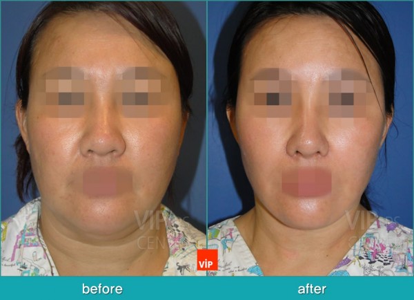 Face Lift - Căng da mặt/cổ High-Smas