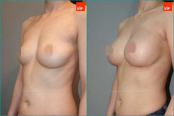 Breast Surgery - Nâng ngực