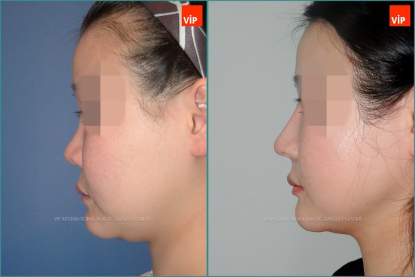 Nose Surgery - Nâng mũi bằng sụn sườn, Nâng vùng giữa mặt