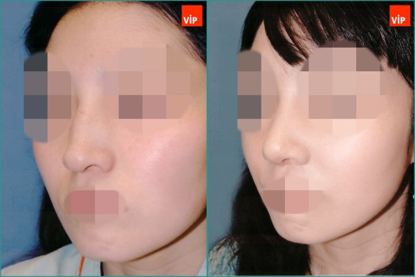 Nose Surgery - Nâng mũi bằng sụn vách ngăn