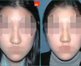 Nâng mũi bằng sụn vách ngăn