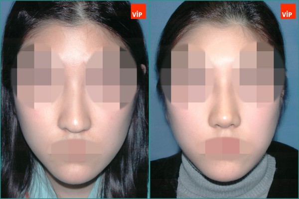 Nose Surgery - Nâng mũi bằng sụn vách ngăn