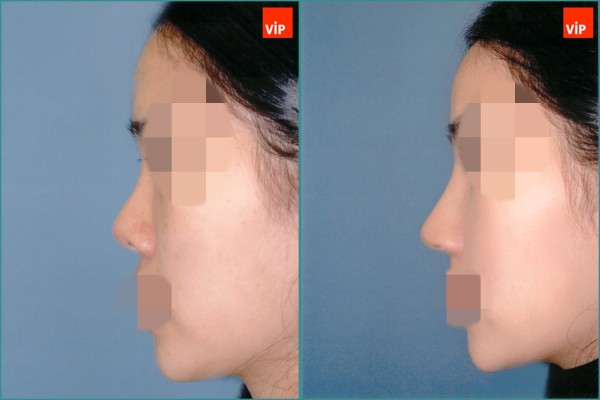 Nose Surgery - Nâng mũi bằng sụn vách ngăn