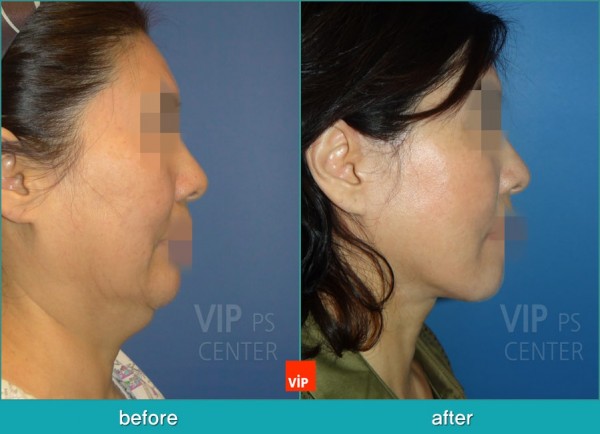 Face Lift - Căng da mặt/cổ High SMAS