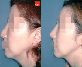 Nâng mũi bằng sụn vách ngăn