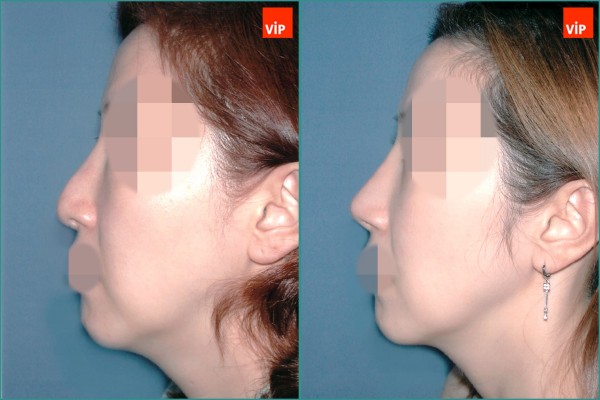 Nose Surgery - Nâng mũi bằng sụn vách ngăn