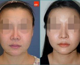 Nâng mũi bằng sụn sườn, Nâng vùng giữa mặt
